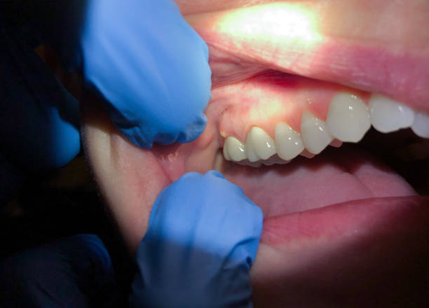 Best Emergency Denture Repair in Silverdale, WA