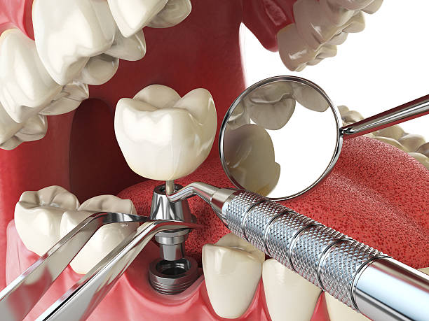 Best Emergency Treatment for Oral Infections in Silverdale, WA